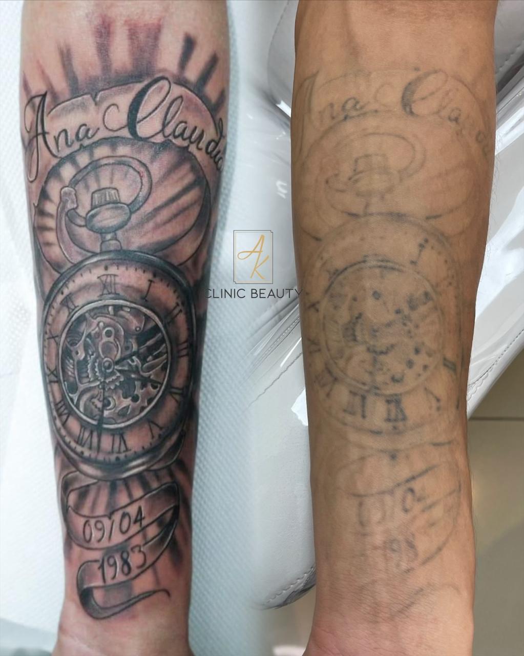 Antes & Depois 3